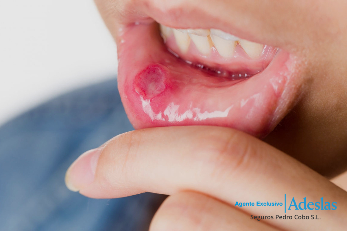 Niño con candidiasis oral